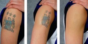 Tetoválás eltávolítása - SkinCare